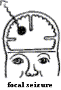 focal seizure focal seizure