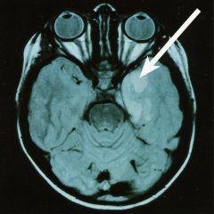 gutartiger Hirntumor